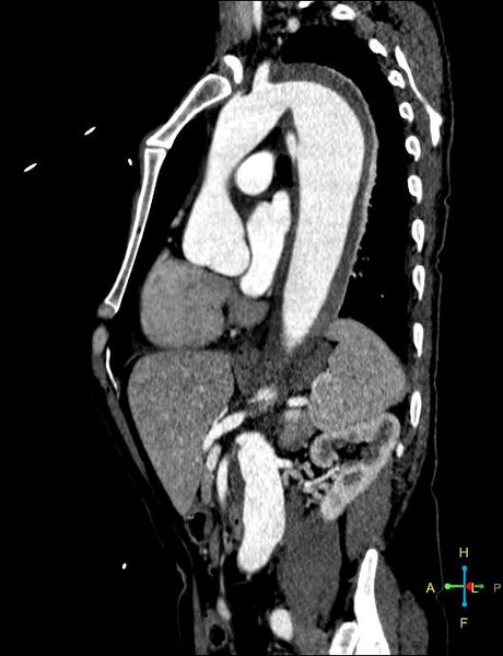 File:Aortic aneurysm and penetrating ulcer (Radiopaedia 23590-23704 C 10).jpg
