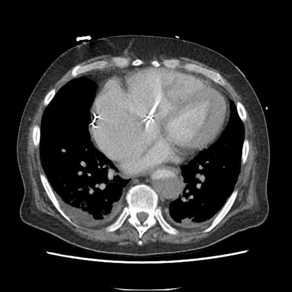 File:Aortic arch graft infection (FDG PET-CT) (Radiopaedia 71975-82437 A 42).jpg