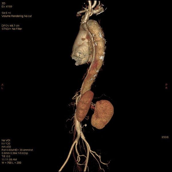 File:Aortic dissection (Radiopaedia 25350-25604 E 8).jpg