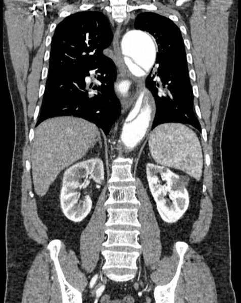 File:Aortic dissection (Radiopaedia 44411-48061 A 39).jpg