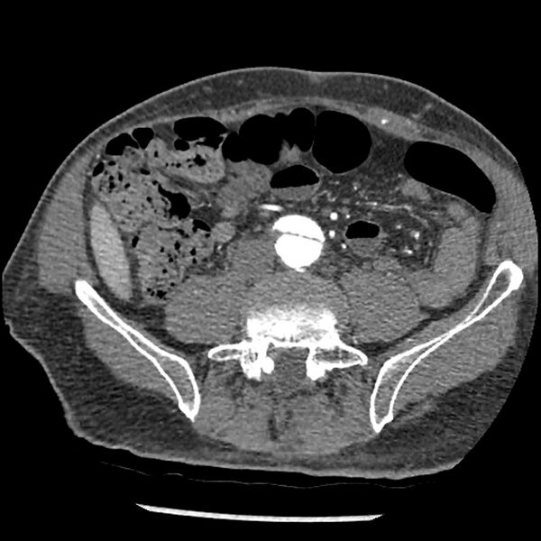 File:Aortic dissection - DeBakey Type I-Stanford A (Radiopaedia 79863-93115 A 63).jpg