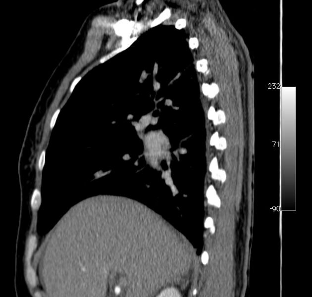 File:Aortic dissection - Stanford type A (Radiopaedia 29247-29659 C 43).jpg