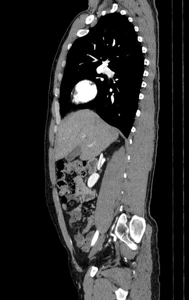 File:Aortic dissection - Stanford type A (Radiopaedia 83418-98500 B 6).jpg