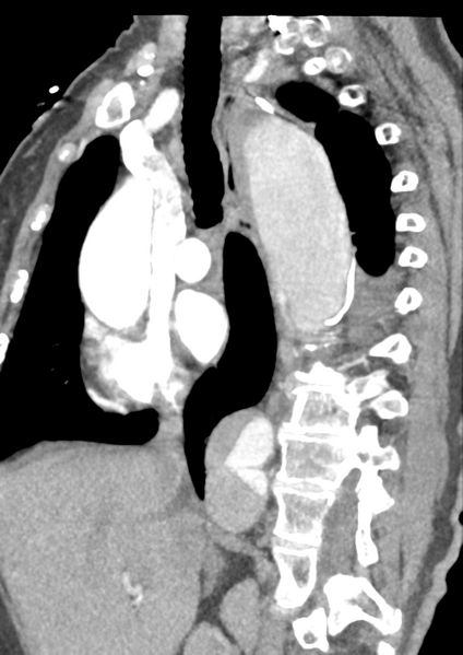 File:Aortic dissection - Stanford type B (Radiopaedia 50171-55512 C 35).png