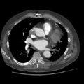 Aorto-coronary bypass graft aneurysms (Radiopaedia 40562-43157 A 64).png