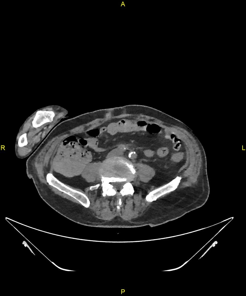 Aortoenteric fistula (Radiopaedia 84308-99603 Axial non-contrast 236).jpg
