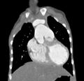 Aortopulmonary window, interrupted aortic arch and large PDA giving the descending aorta (Radiopaedia 35573-37074 D 17).jpg