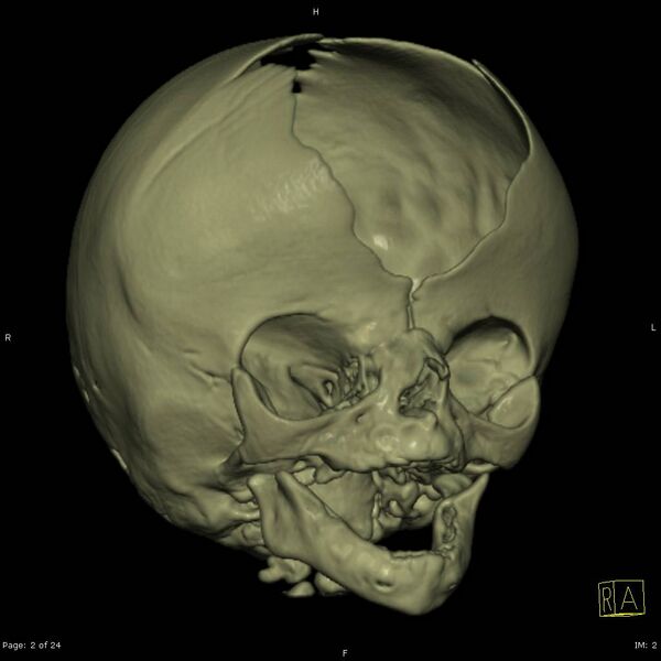File:Apert syndrome with syndactyly (Radiopaedia 10315-10834 3D MPR bone window 2).jpg