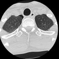 Apical pneumothorax on cervical spine CT (Radiopaedia 45343-49368 Axial lung window 11).jpg