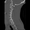 Apical pneumothorax on cervical spine CT (Radiopaedia 45343-49368 Sagittal bone window 8).jpg