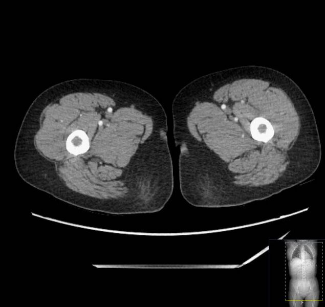 File:Appendicitis (CT angiogram) (Radiopaedia 154713-127660 Axial 142).jpg