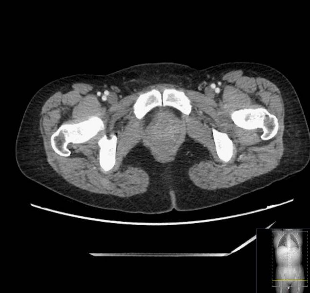 File:Appendicitis (CT angiogram) (Radiopaedia 154713-127660 Axial 86).jpg