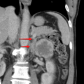 Appendicitis and renal cell carcinoma (Radiopaedia 17063-18402 D 1).png
