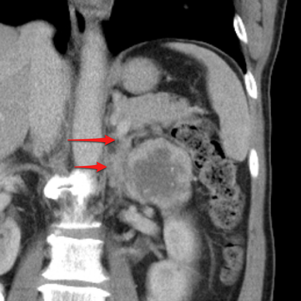 File:Appendicitis and renal cell carcinoma (Radiopaedia 17063-18402 D 1).png