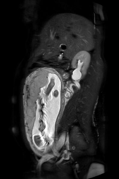 File:Appendicitis in gravida (MRI) (Radiopaedia 89433-106395 Sagittal T2 SPAIR 40).jpg