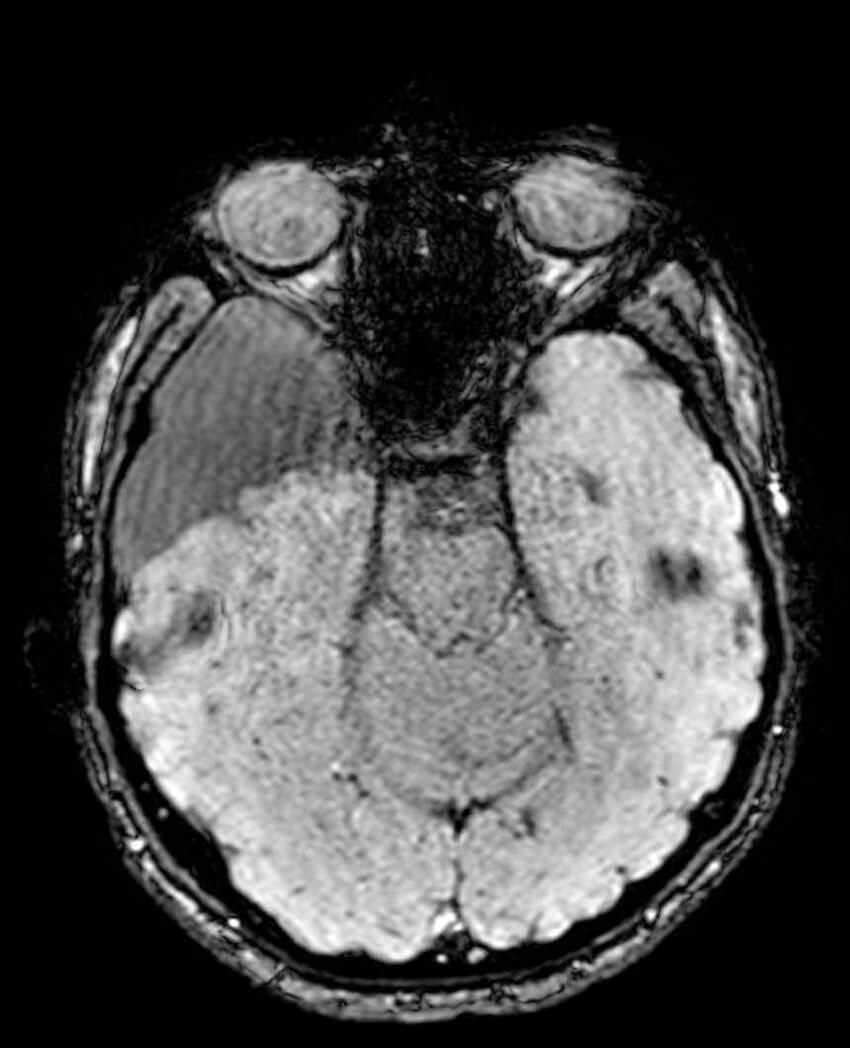 Arachnoid cyst- extremely large (Radiopaedia 68741-78451 Axial SWI 22).jpg