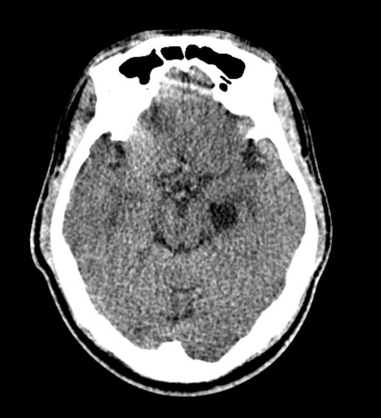 File:Arachnoid cyst of the ambient cistern (Radiopaedia 81301-94986 Axial non-contrast 27).jpg