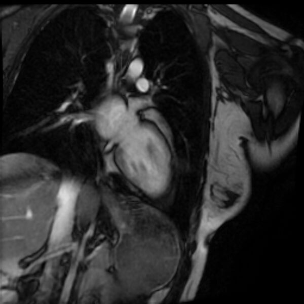 File:Arrhythmogenic right ventricular cardiomyopathy (Radiopaedia 87505-103850 2ch (LV) Cine SSFP 52).jpg