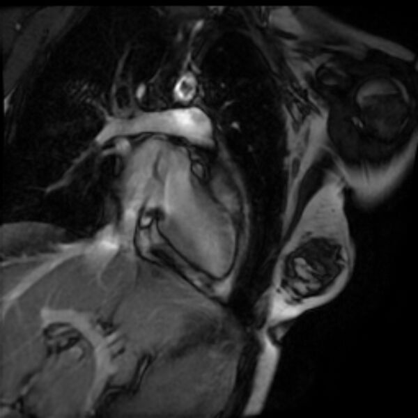 File:Arrhythmogenic right ventricular cardiomyopathy (Radiopaedia 87505-103850 2ch (LV) Cine SSFP 7).jpg