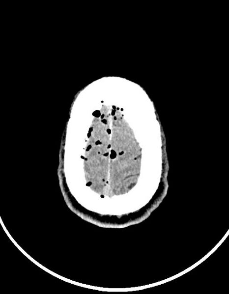 File:Arrow injury to the brain (Radiopaedia 72101-82607 Axial 85).jpg