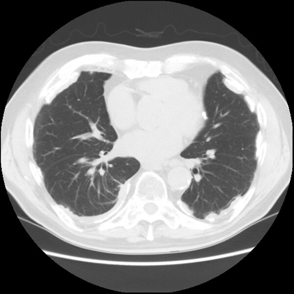 File:Asbestos-related pleural plaques (Radiopaedia 39069-41255 Axial lung window 45).jpg