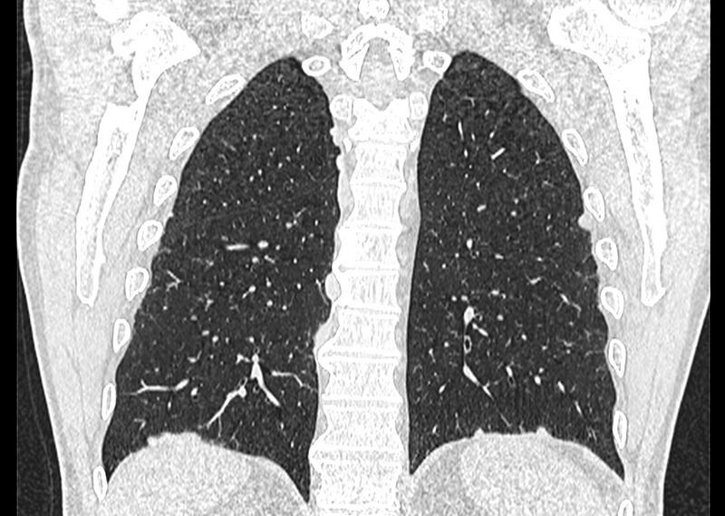 File:Asbestos pleural placques (Radiopaedia 57905-64872 Coronal lung window 222).jpg