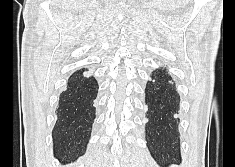 File:Asbestos pleural placques (Radiopaedia 57905-64872 Coronal lung window 263).jpg