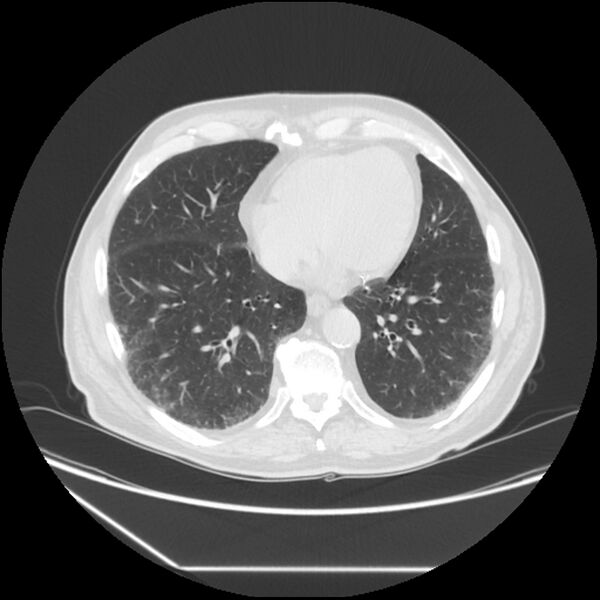 File:Asbestosis complicated by lung cancer (Radiopaedia 45834-50116 Axial lung window 48).jpg
