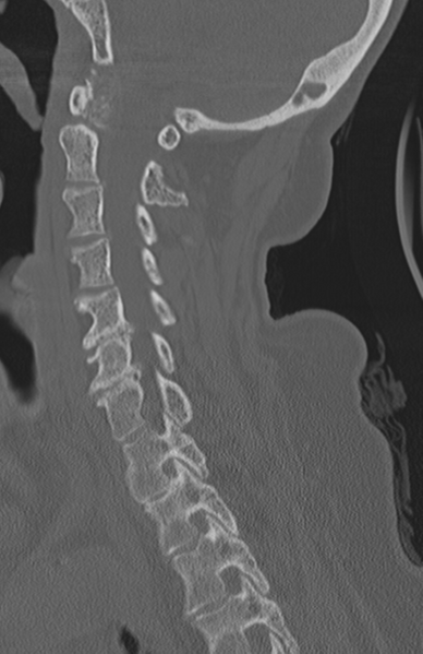 File:Atlanto-axial subluxation (Radiopaedia 36610-38176 Sagittal bone window 36).png