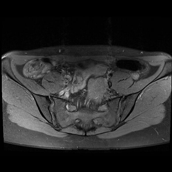 File:Atypical deep infiltrating endometriosis (Radiopaedia 44470-48125 Axial T1 fat sat 4).jpg