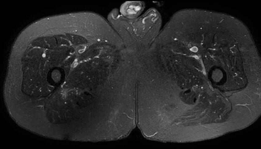 Atypical lipomatous tumor - thigh (Radiopaedia 68975-78734 Axial T2 fat sat 72).jpg