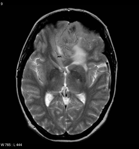 File:Atypical meningioma (WHO grade II) (Radiopaedia 7762-8586 Axial T2 1).jpg