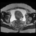 Atypical retroperitoneal lymphocoeles with large leiomyoma of uterus (Radiopaedia 32084-33027 Axial T2 24).jpg