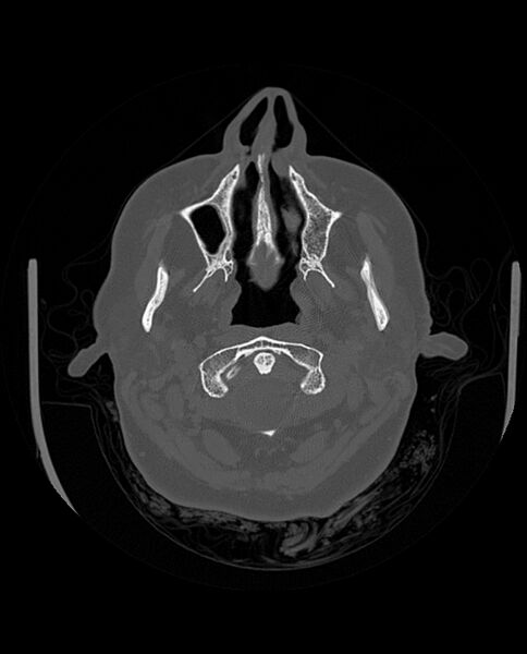 File:Automastoidectomy with labyrinthine fistula (Radiopaedia 84143-99411 Axial non-contrast 44).jpg