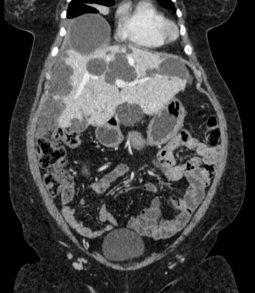 File:Autosomal dominant polycystic kidney disease (Radiopaedia 57124-64017 B 23).jpg