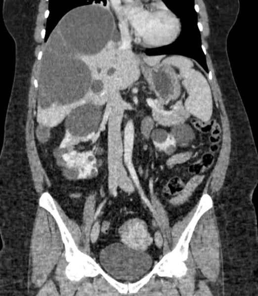 File:Autosomal dominant polycystic kidney disease (Radiopaedia 57124-64017 B 39).jpg