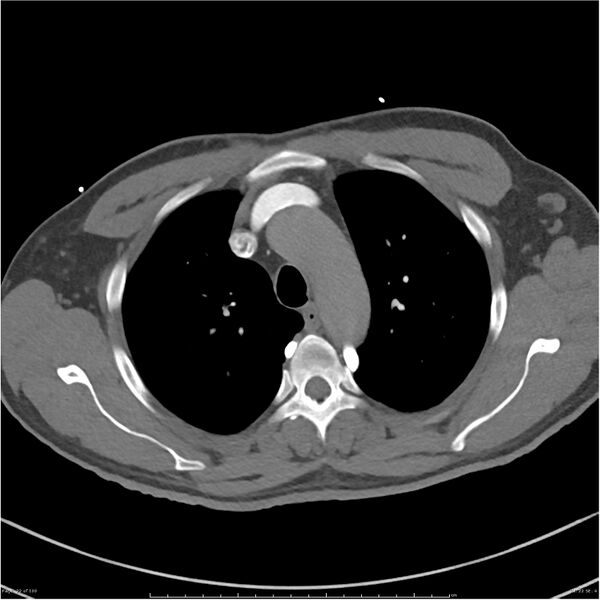 File:Azygos venous system anatomy (CT pulmonary angiography) (Radiopaedia 25928-26077 Axial C+ CTPA 22).jpg