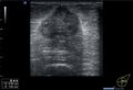 BIRADS 5 lesion with axillary lymphadenopathy (Radiopaedia 62315).jpg