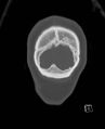 Base of skull fracture with bilateral Le Fort fractures (Radiopaedia 47094-51638 Coronal bone window 4).jpg