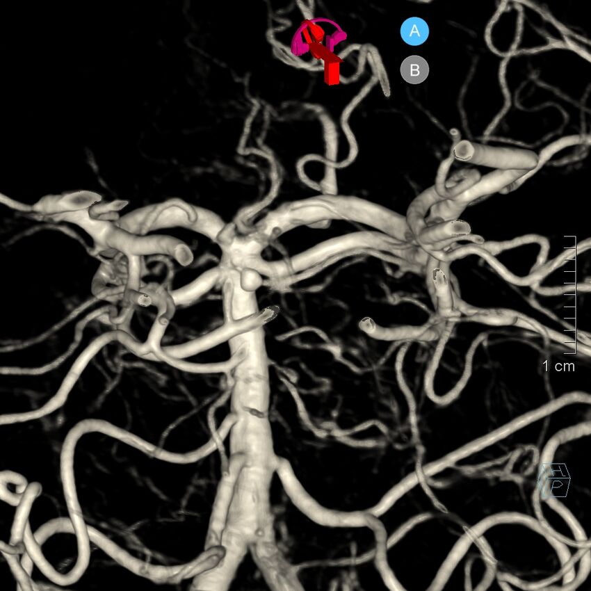 Basilar artery perforator aneurysm (Radiopaedia 82455-97734 3D view left VA 163).jpg