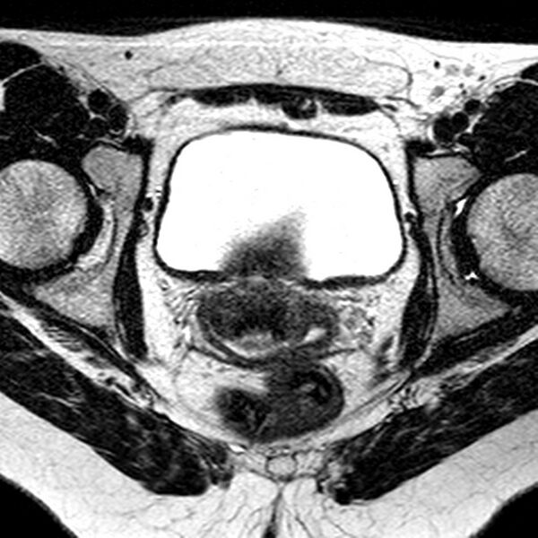 File:Bicornuate uterus (Radiopaedia 11104-11492 Axial T2 15).jpg