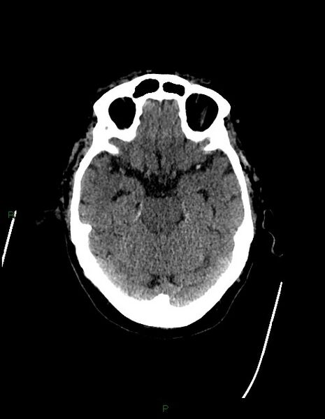 File:Bilateral acute middle cerebral artery territory infarcts (Radiopaedia 77319-89401 Axial non-contrast 30).jpg