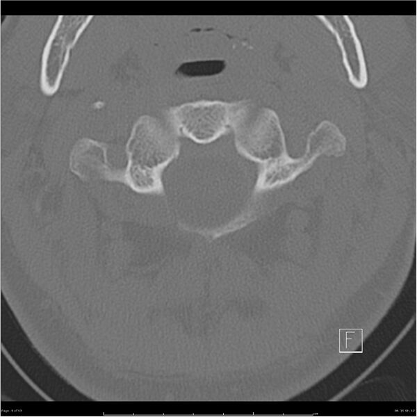 File:Bilateral cervical ribs (Radiopaedia 25868-26017 Axial bone window 9).jpg