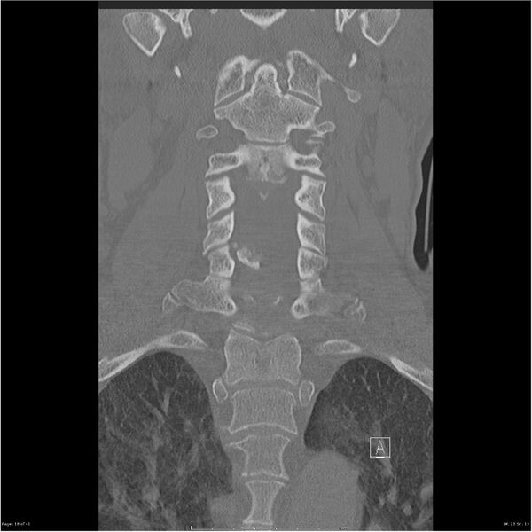File:Bilateral cervical ribs (Radiopaedia 25868-26017 Coronal bone window 18).jpg