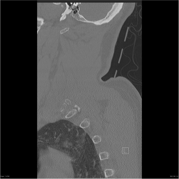 File:Bilateral cervical ribs (Radiopaedia 25868-26017 Sagittal bone window 7).jpg