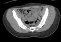 Bilateral mature cystic ovarian teratoma (Radiopaedia 88821-105592 Axial non-contrast 6).jpg