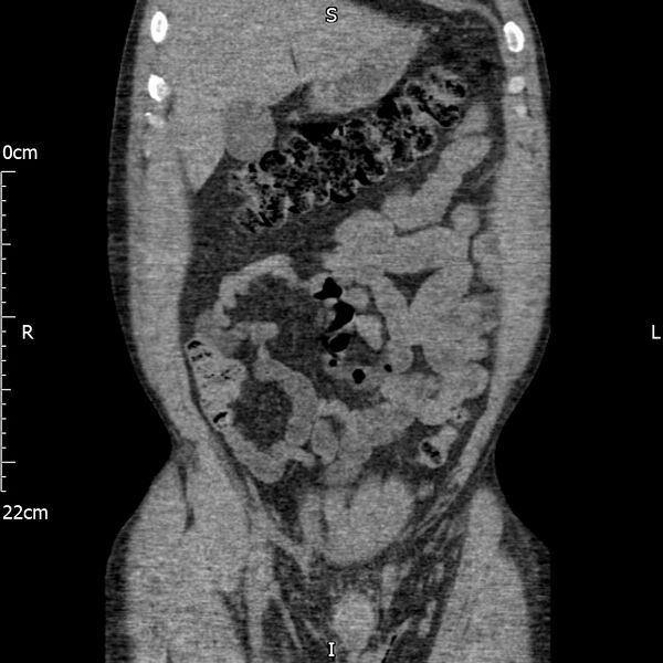 File:Bilateral medullary nephrocalcinosis with ureteric calculi (Radiopaedia 71269-81569 Coronal non-contrast 17).jpg