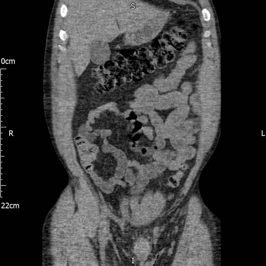 Bilateral medullary nephrocalcinosis with ureteric calculi (Radiopaedia 71269-81569 Coronal non-contrast 17).jpg