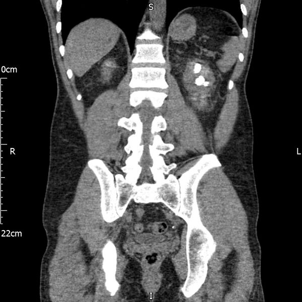 File:Bilateral medullary nephrocalcinosis with ureteric calculi (Radiopaedia 71269-81569 Coronal non-contrast 51).jpg
