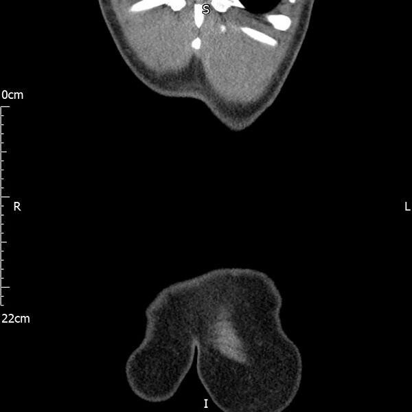 File:Bilateral medullary nephrocalcinosis with ureteric calculi (Radiopaedia 71269-81569 Coronal non-contrast 75).jpg